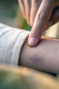 Applying topical ointment to a bruised arm