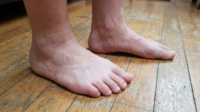 Flat foot orthopedic: medical condition, plantar arch, human limb, skeletal structure, bare sole, skin texture, wooden floor, male ankle, physical therapy, clinical assessment, body posture.