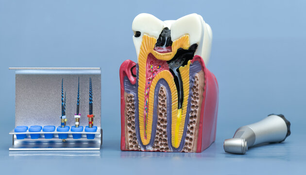 Anatomical tooth model showing deep decay and root canal structure next to endodontic rotary files and dental handpiece on blue background.