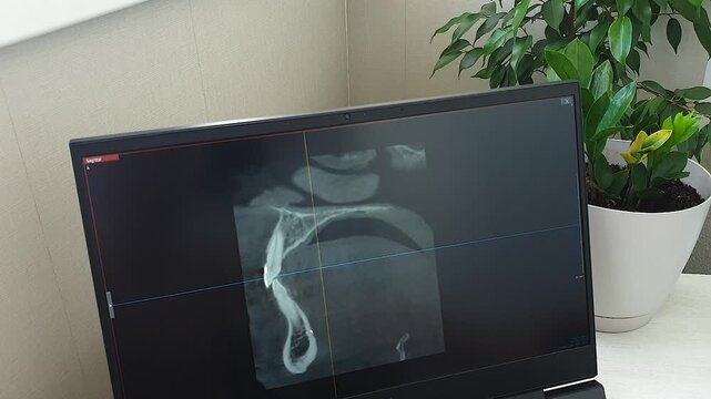 Dental CT Scan Sagittal Slice View on Monitor Screen. Dental