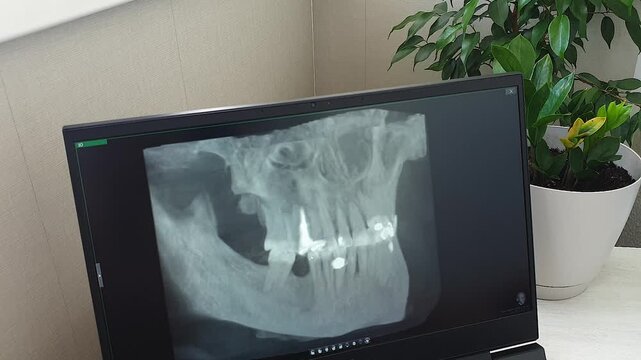Dental Panoramic X-Ray Radiograph on Screen Showing Missing Teeth Gap. Dental