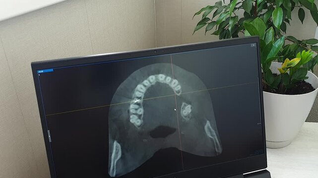 Dental CT Scan Axial Slice View of Dental Arch on Monitor Screen. Dental