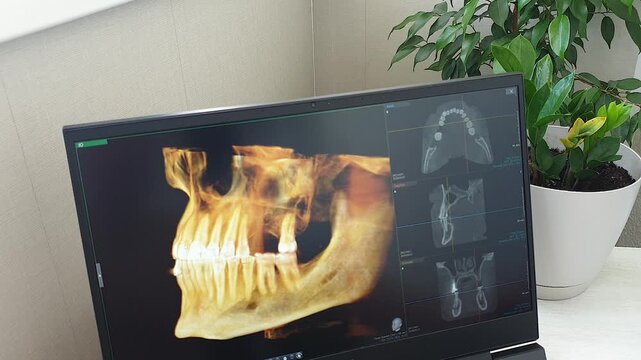 Interactive 3D Dental CBCT Software Interface Showing Jawbone Volume Rendering. Dental