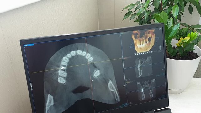 Dental CBCT Diagnostic Software Displaying Multi-View Quadrant Layout on Monitor. Dental