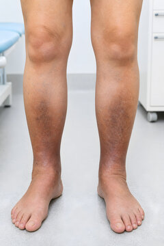 Bilateral CEAP C4b lipodermatosclerosis of lower legs