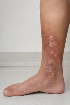Atrophie blanche scars on hyperpigmented lower leg