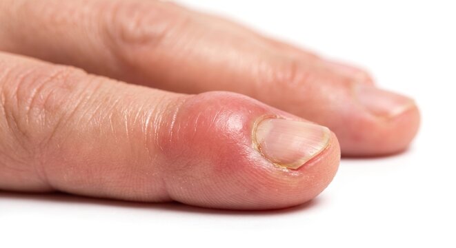Close up of swollen red paronychia infection around fingernail fold