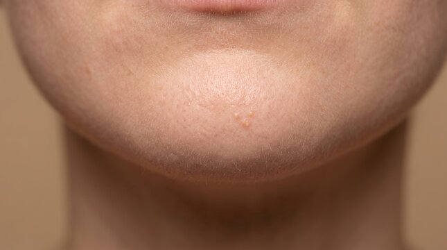 Close up photo of small whitehead pimples and milia bumps on human chin