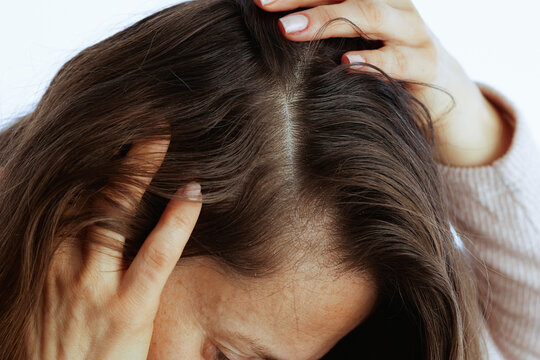 A close-up of a woman touching the crown of her head, revealing visible dandruff flakes on her scalp and suggesting a need for specialized hair and scalp treatment.