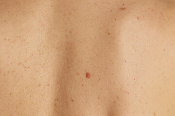 Fototapeta premium A detailed shot of a womans upper back showing natural skin texture, numerous freckles, sunspots, and a central mole, highlighting dermatology and skin health awareness.
