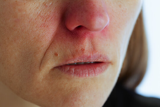 A womans face shown in close-up with noticeable redness around the nose and dry, chapped lips, focusing on common symptoms of seasonal illness or skin sensitivity.