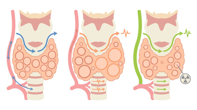 Medical illustration of thyroid gland stages, showing healthy function, hyperthyroidism symptoms, and radioactive iodine treatment pathways