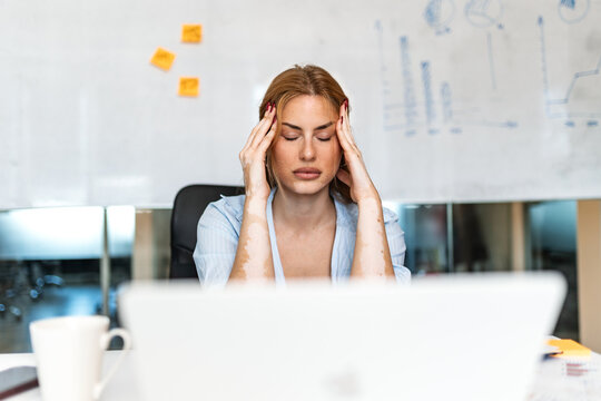 Stressed young businesswoman with vitiligo experiencing a bad headache, holding her temples in pain while working at a desk with a laptop in a modern office environment.