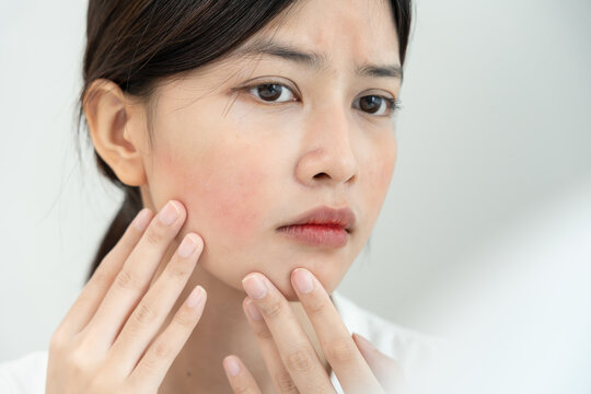 Woman worried about face Dermatology, rosacea dermatitis, allergic steroids, sensitive skin, red face from sunburn, acne, dry skin, large pores ,rash face, dull, freckles, wrinkle, skin problem,