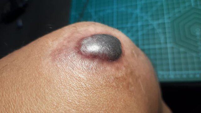 Macro shot of a large hemorrhagic bulla and blood blister on a human knee after trauma