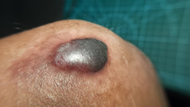 Macro shot of a large hemorrhagic bulla and blood blister on a human knee after trauma