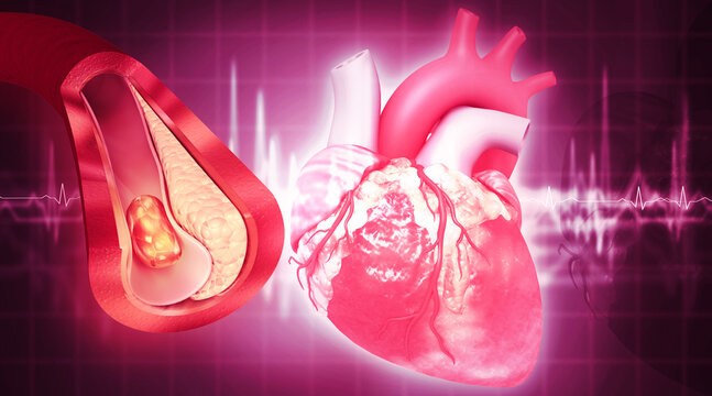 Realistic 3D human heart illustration showing coronary artery disease with yellow cholesterol plaque.