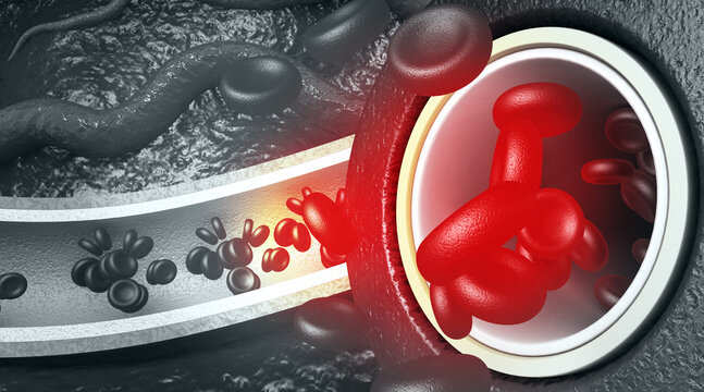Medical 3D illustration showing yellow cholesterol plaque buildup narrowing a human blood artery.