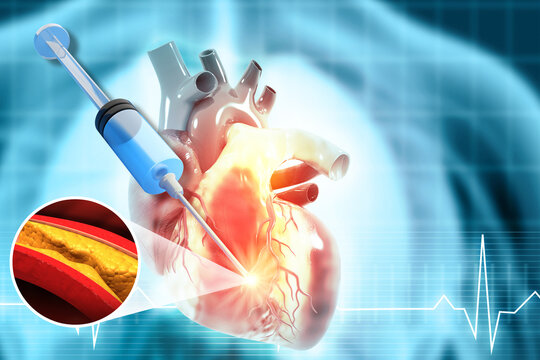 Human heart anatomy showing cholesterol blocked arteries with a medical treatment injection. 3d illustration