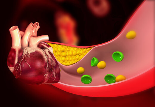 Human heart anatomical model showing severely clogged arteries with yellow plaque buildup. 3d illustration