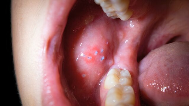 Koplik Spots on Buccal Mucosa in Patient with Measles Infection