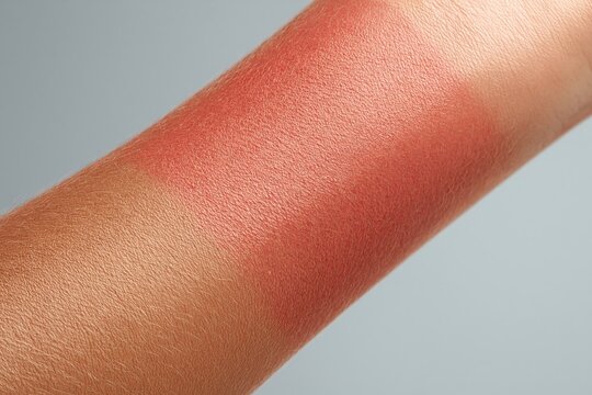 medical UV damage concept. dermatological care, UV exposure awareness . Close-up view of human arm showing skin irritation and redness on forearm