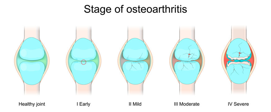 Stages of Osteoarthritis. Cartilage degradation, bone spur progression.