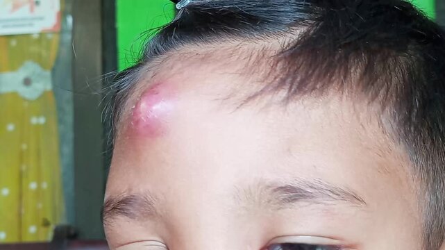 Medically, the cause of a boil is a bacterial infection of a hair follicle, most commonly triggered by *Staphylococcus aureus* bacteria. These bacteria normally live on the surface of human skin.