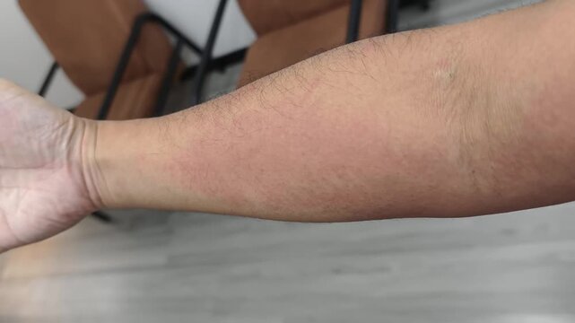 An urticaria due to acute allergy reaction.Its a diffuse, patchy, erythematous (red) rash covering of the inner forearm and extending across the antecubital fossa (crease of the elbow). 