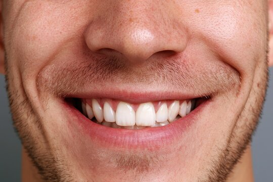 Photographic close-up of a man's smile with misaligned upper teeth before orthodontic treatment