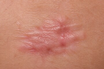 Fototapeta premium Skin scar healed raised area close up on flesh surface medical