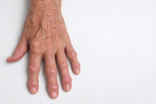 Hand with Heberden's Nodes from Osteoarthritis Isolated on White Background with Copy Space