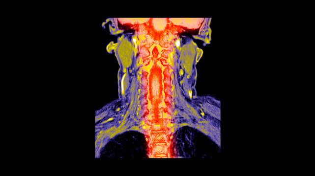 Coronal magnetic resonance image of the neck showing cervical vertebrae and skull base in warm yellow, red and violet false colour on black background.