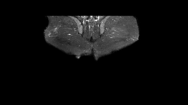 Pelvic MRI Fistulogram Sequence Showing Perianal Fistula Tract Ischioanal Fossa Soft Tissue Infiltration and Pelvic Anatomy