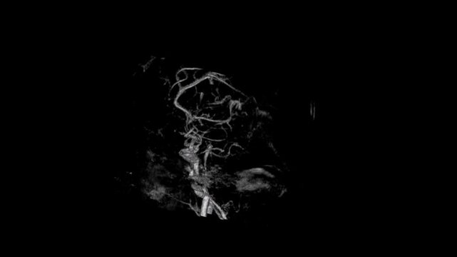 3D Brain MRA Volume Rendering Rotating View Showing Circle of Willis Cerebral Arteries and Intracranial Vascular Tree