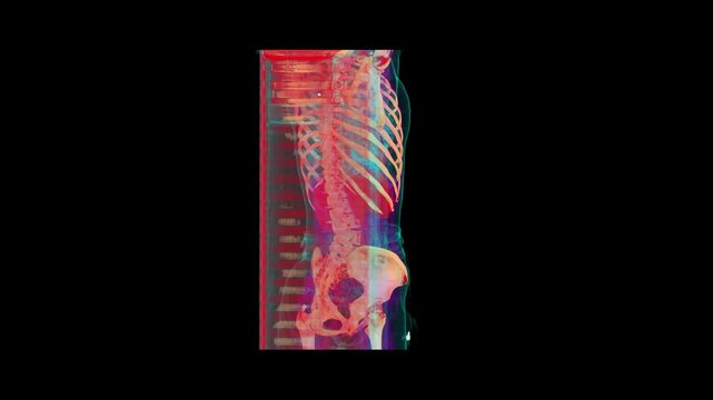 3D Cinematic Anaglyph Full Torso CT Scan Render Showing Spine Rib Cage Heart and Pelvis Girdle Anatomy