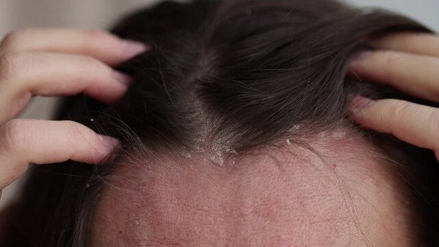 Closeup dandruff flakes on the scalp of a woman. 4K, slow motion.