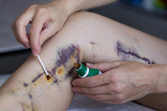 Treatment of wounds some days after innovative method of varicose veins surgery, sclerotherapy procedure. Close-up shot of patient legs. 4K