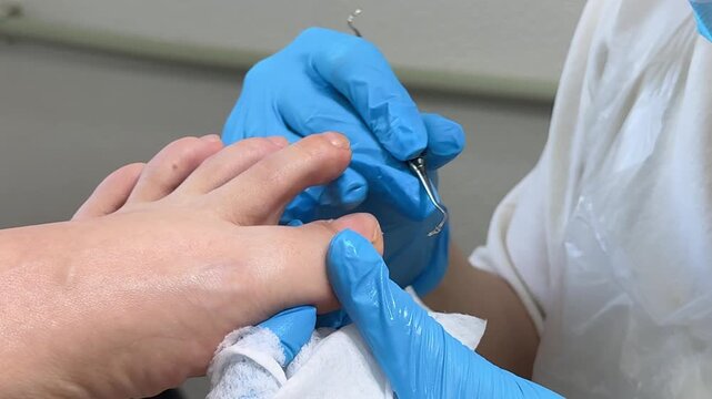 A podiatrist wearing blue protective gloves performs a professional medical pedicure, carefully treating the patient's feet with precision, hygiene and clinical care. Close up.