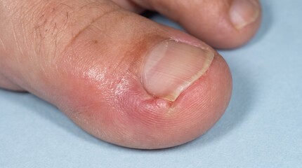 Fototapeta premium Ingrown Toenail Onychocryptosis
