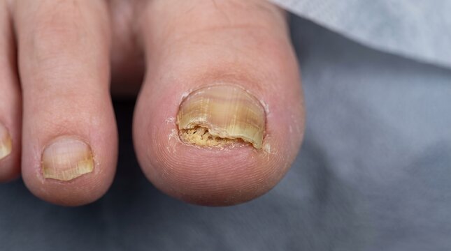 Onychomycosis Fungal Nail Infection