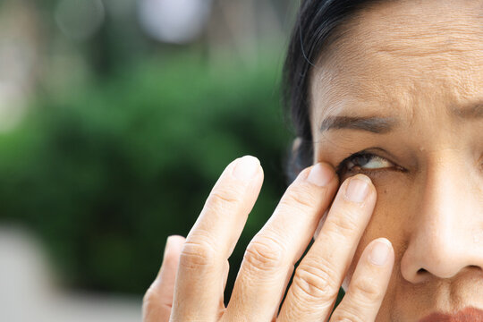 Middle aged Asian woman touching eyelid bump old aged health condition, eye closeup shot