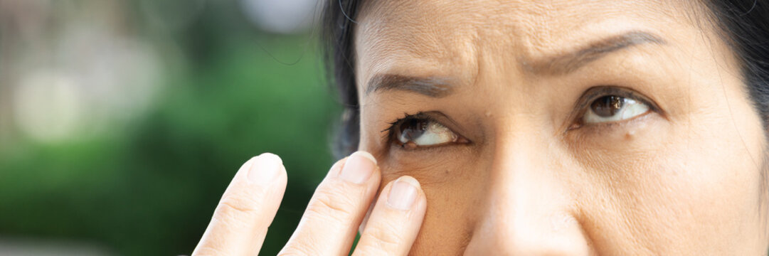 Middle aged Asian woman touching eyelid bump old aged health condition, eye closeup shot