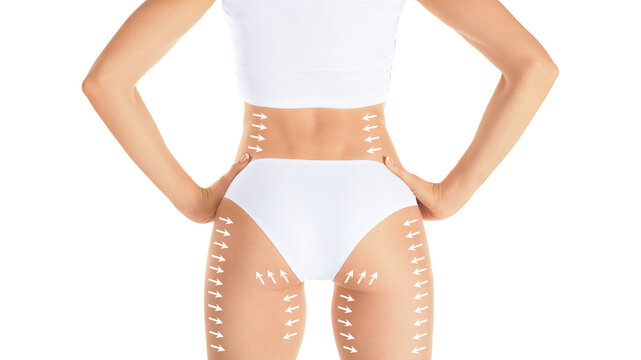 Beautiful woman body in white underwear with markup arrows pointing upwards on her waist, buttocks and thighs for aesthetic surgery and lifting procedures, back view.