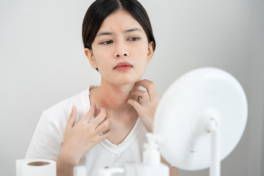skin problem and beauty. woman scratch body has itchy skin from skin allergic, steroid allergy, sensitive skin, red from sunburn, chemical allergy, rash, insect bites, Seborrheic Dermatitis.