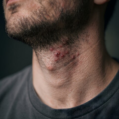 Naklejka premium Man displays a cluster of inflamed skin blemishes and acne on his neck area near his beard line.