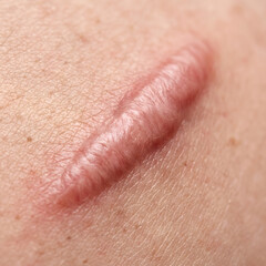 Fototapeta premium Scar tissue forms a raised pink ridge on the human skin surface following a previous injury.