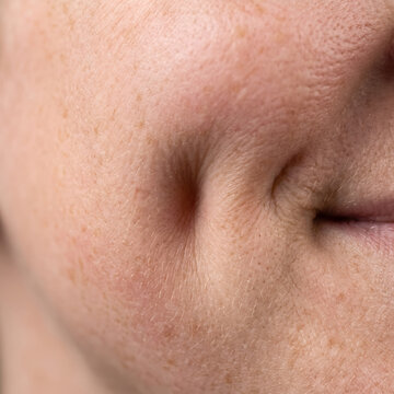 Cheek shows a noticeable dimple on a person with fair skin and natural facial texture details.