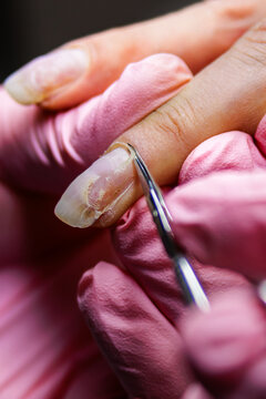 Manicurist working on client nail, treating visible fungal infection or damage