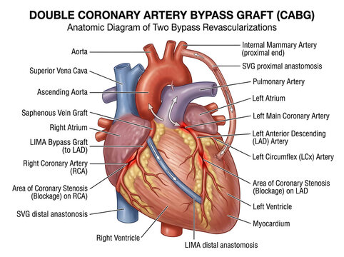 Double coronary artery bypass graft surgical diagram isolated on white background